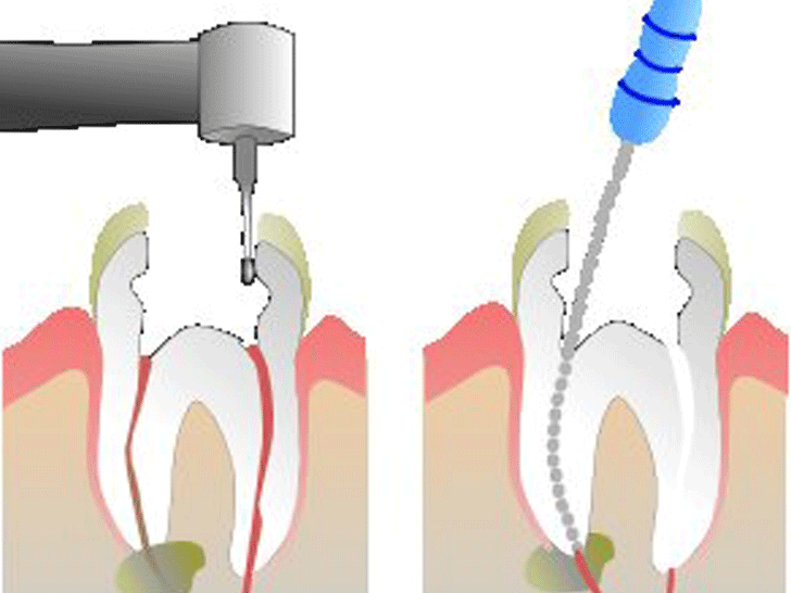  Root Canal Treatments, colombo , wellawatta