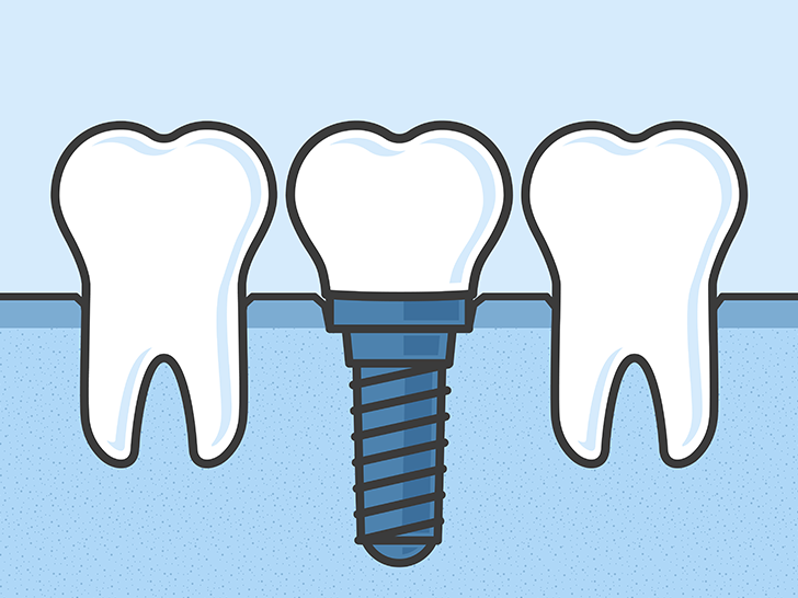  Dental Implants colombo , wellawatta